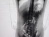 Adolescente de 13 anos é flagrada por scanner corporal com droga no corpo em presídio de Chapecó; mãe é presa
