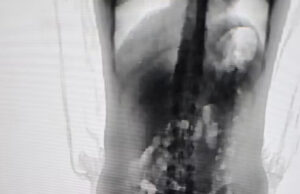 Adolescente de 13 anos é flagrada por scanner corporal com droga no corpo em presídio de Chapecó; mãe é presa